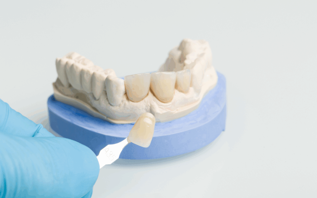 Do You Need a Dental Crown? Here’s What You Should Know