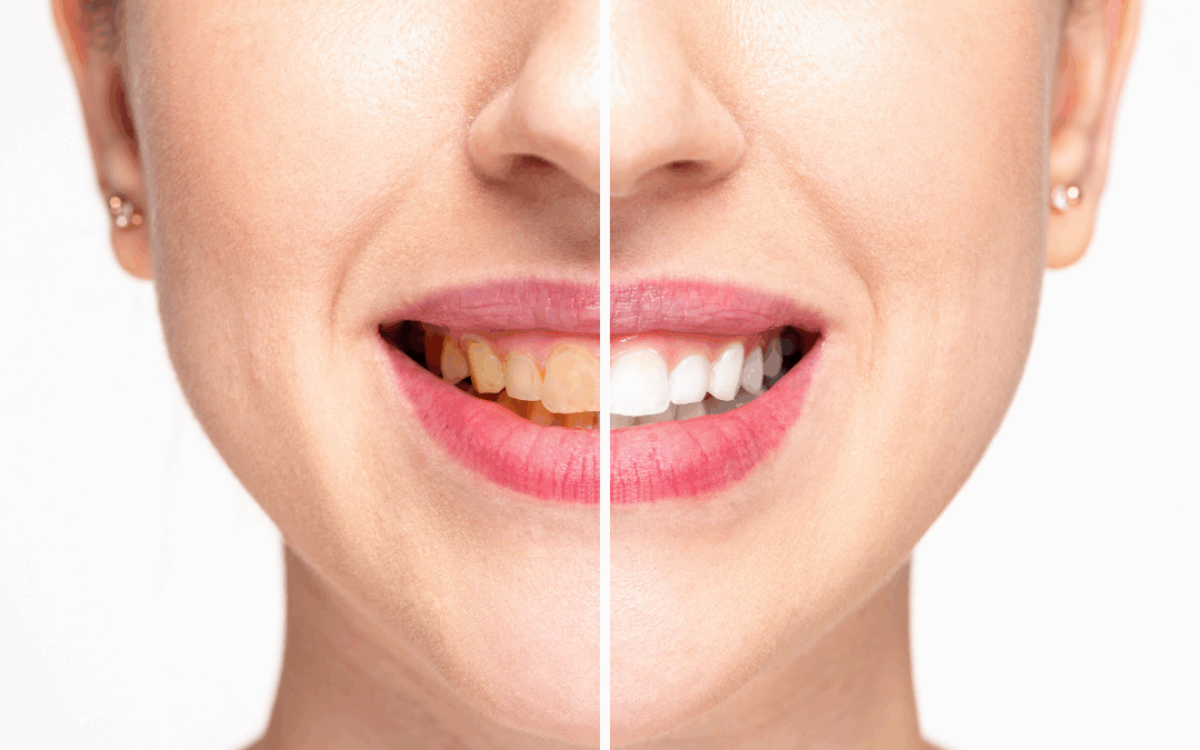 How Teeth Whitening Works: What You Need to Know Before You Brighten Your Smile