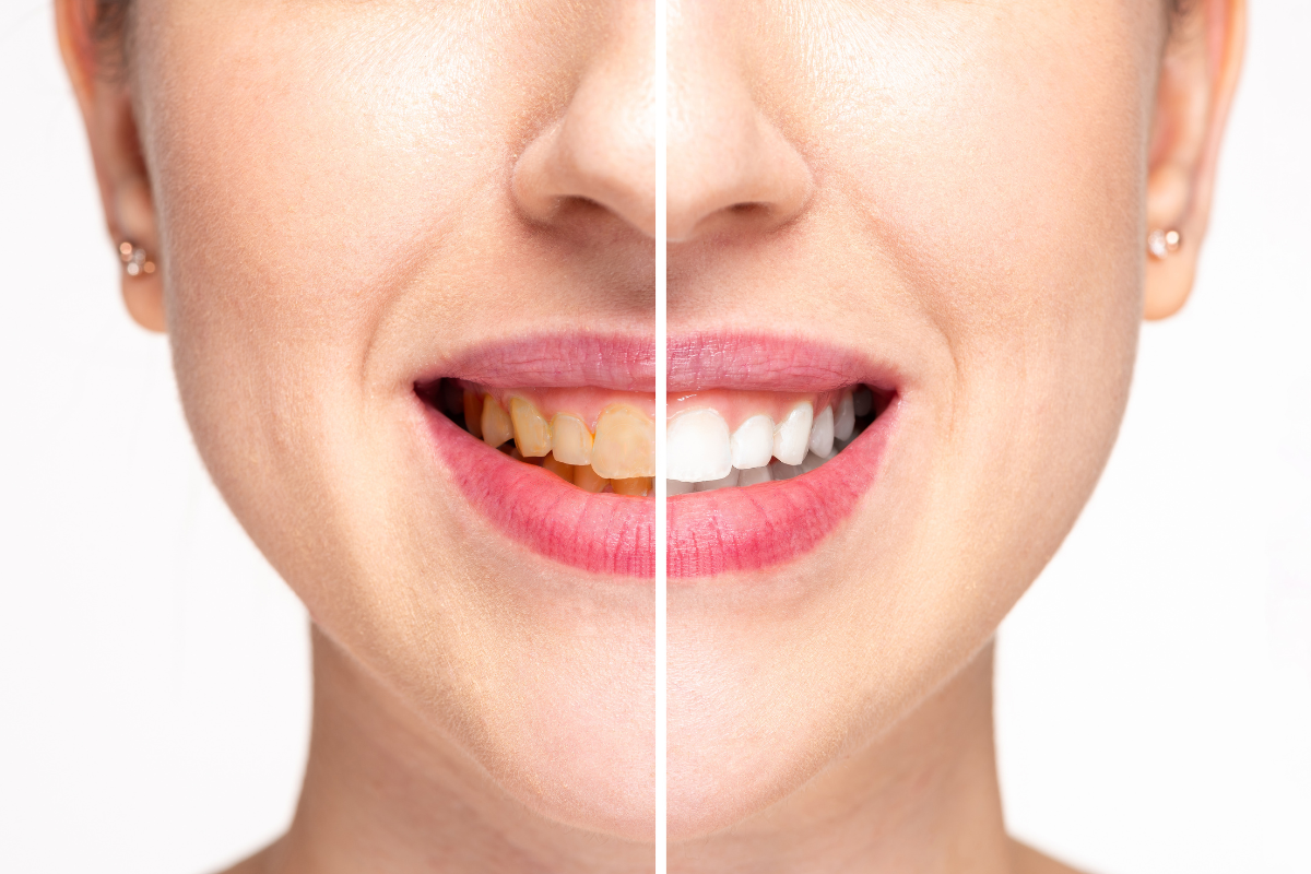 How Teeth Whitening Works What You Need to Know Before You Brighten Your Smile