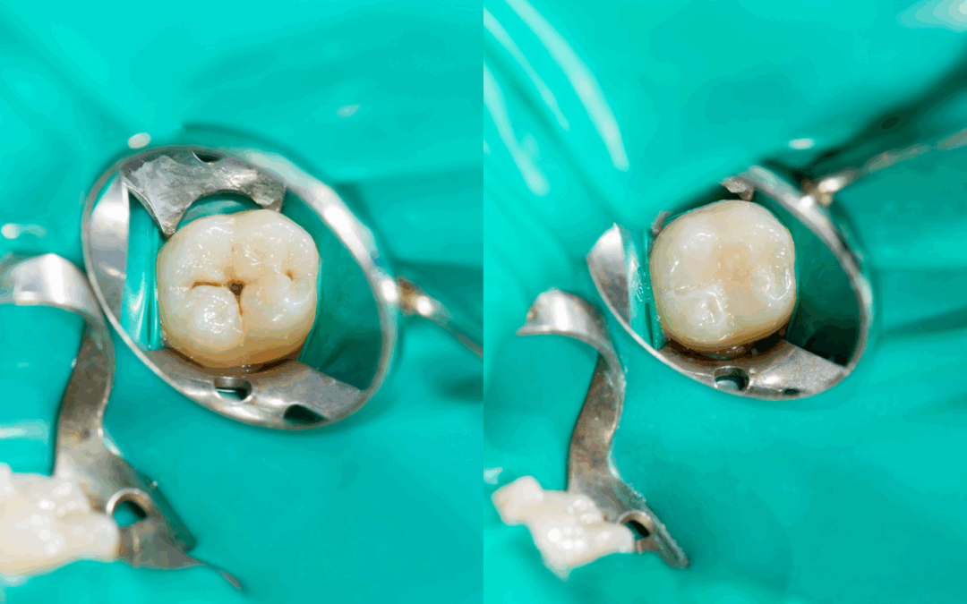 What Are Dental Fillings and How Do They Protect Your Teeth?