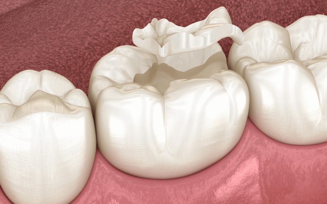 What Are Dental Sealants? Your Complete Guide to Cavity Prevention