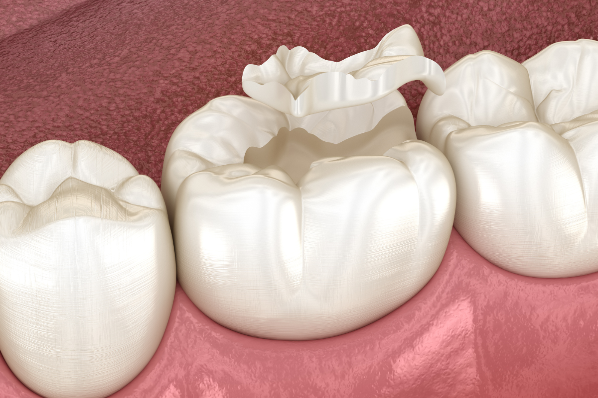 What Are Dental Sealants Your Complete Guide to Cavity Prevention What Are Dental Sealants Your Complete Guide to Cavity Prevention