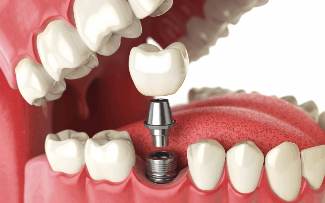 Benefits of Implant-Supported Dentures: A Permanent Solution to Missing Teeth