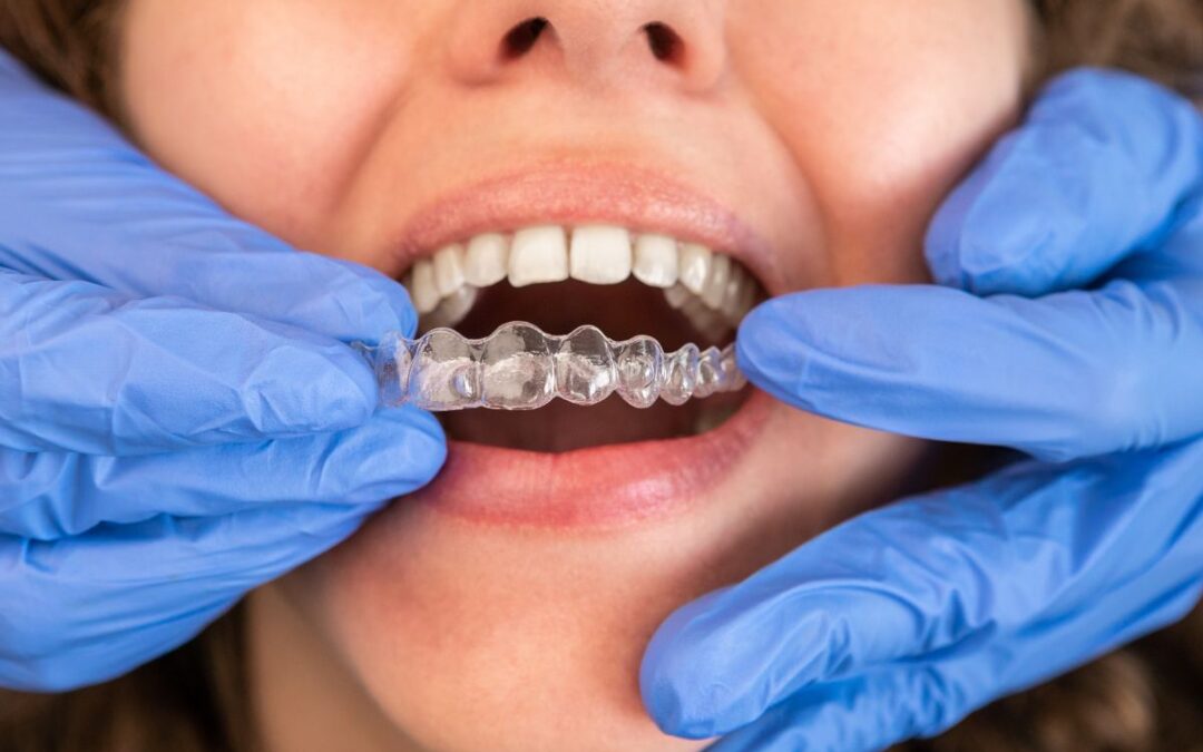 Can Invisalign Fix an Underbite?