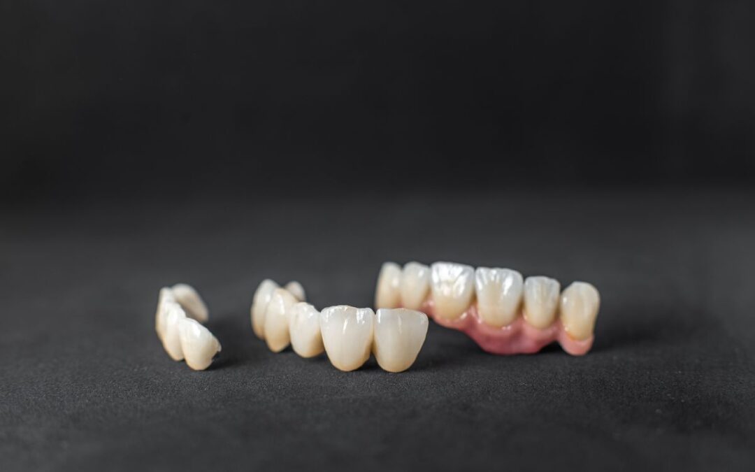 Can a Tooth Rot Under A Crown?