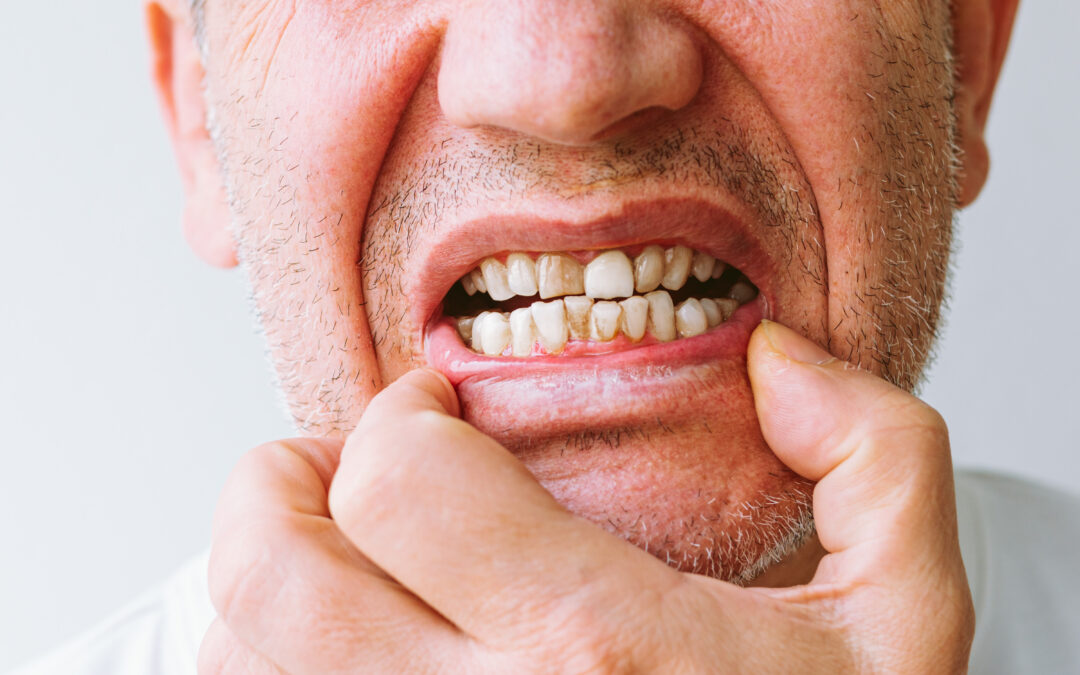 Why Do I Have Black or Brown Spots on My Teeth?
