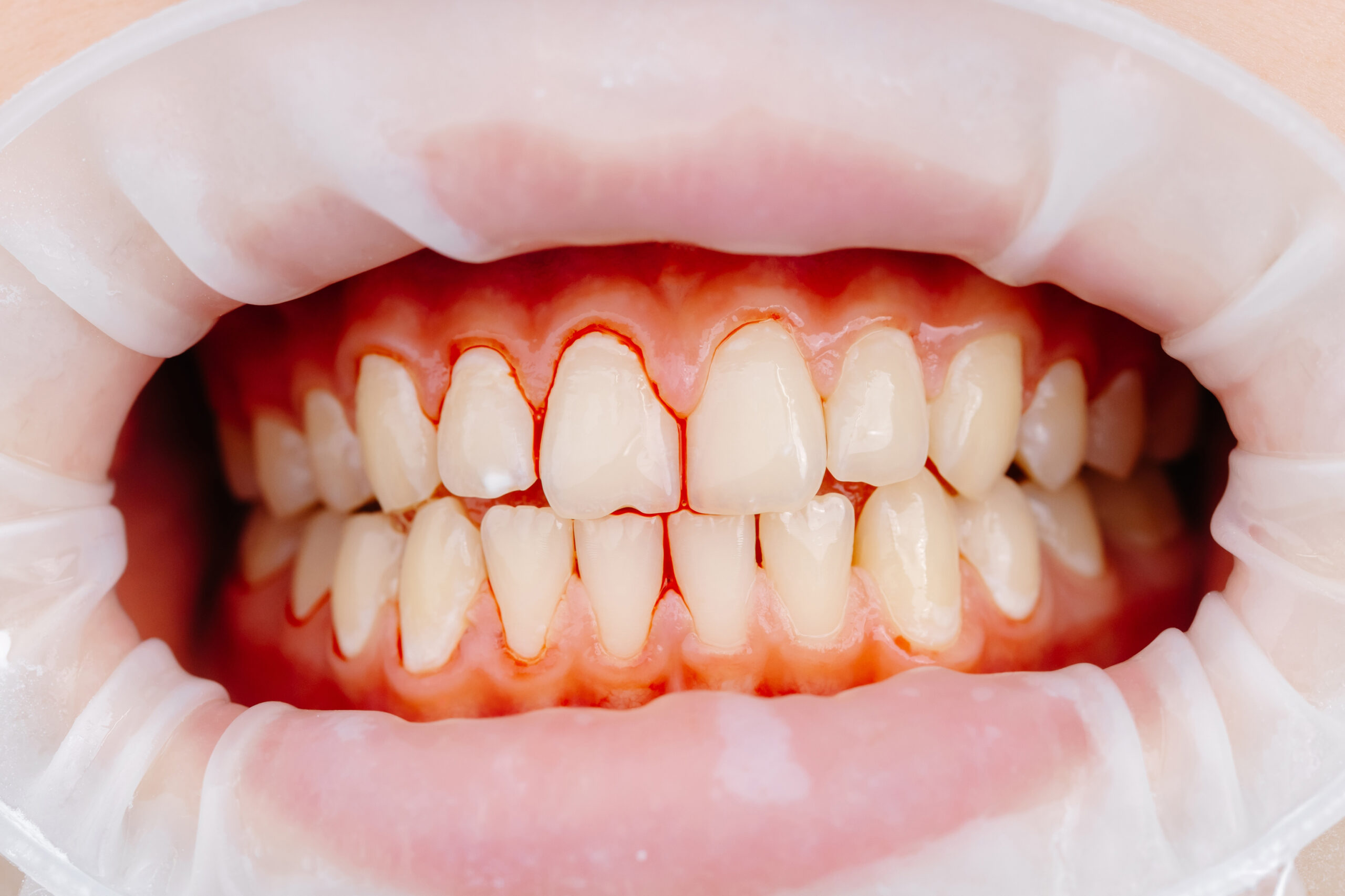 Close-up view of inflamed and bleeding gums around teeth during a dental examination, showing early signs of gum irritation and gingivitis