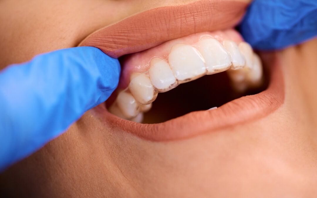 Your Teeth Are Shifting as an Adult — Here’s Why Invisalign in San Marcos Might Be the Window You Didn’t Know Was Closing