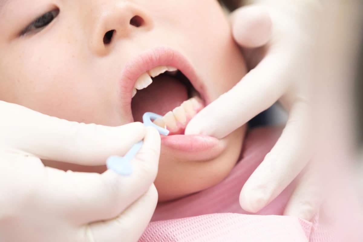 Dental sealants application for kids