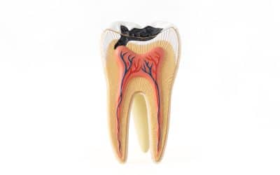 Can You Save a Tooth With a Deep Crack? What Dentists Want You to Know