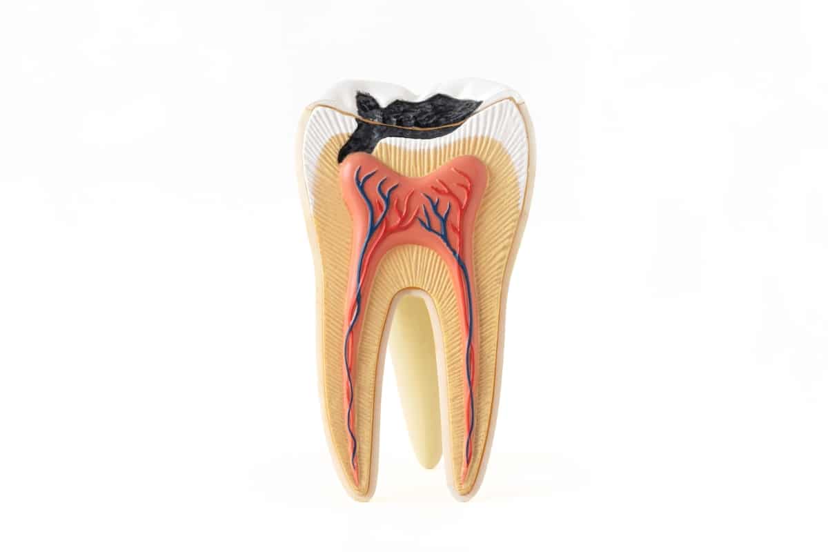 root canal for treating deep cracks Root canal for treating deep cracks